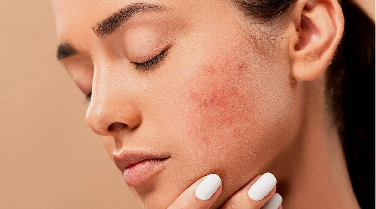 ملاسما چیست؟ | علت لک صورت، انواع لک پوستی و بهترین روش‌های درمان و رفع لک